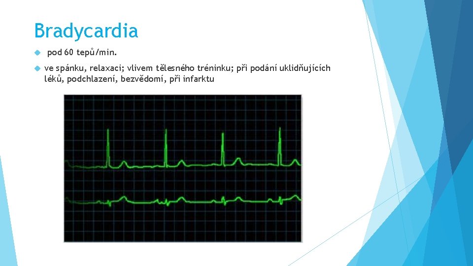 Bradycardia pod 60 tepů/min. ve spánku, relaxaci; vlivem tělesného tréninku; při podání uklidňujících léků,