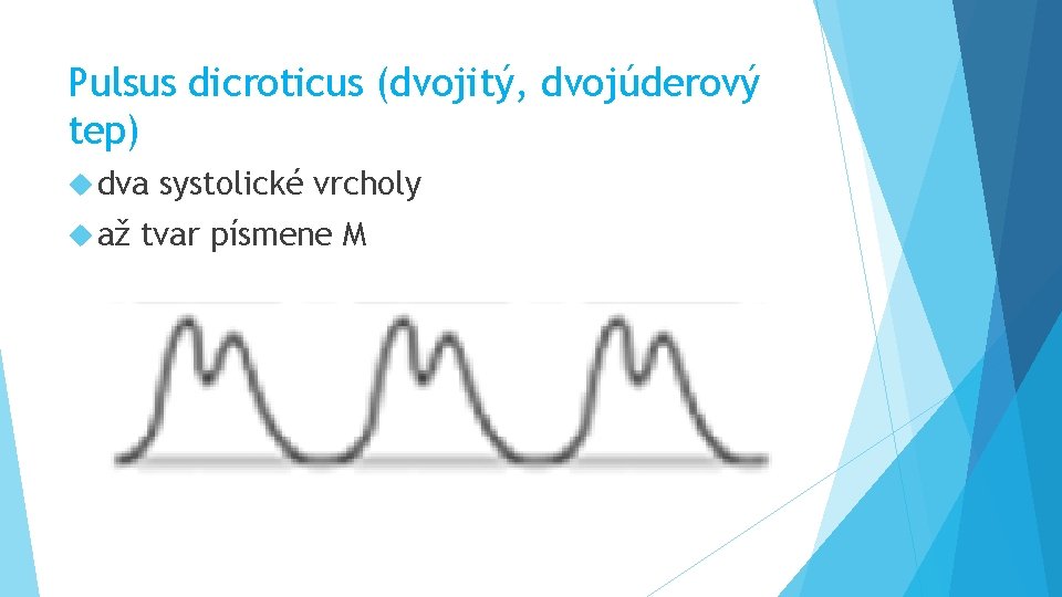 Pulsus dicroticus (dvojitý, dvojúderový tep) dva až systolické vrcholy tvar písmene M 