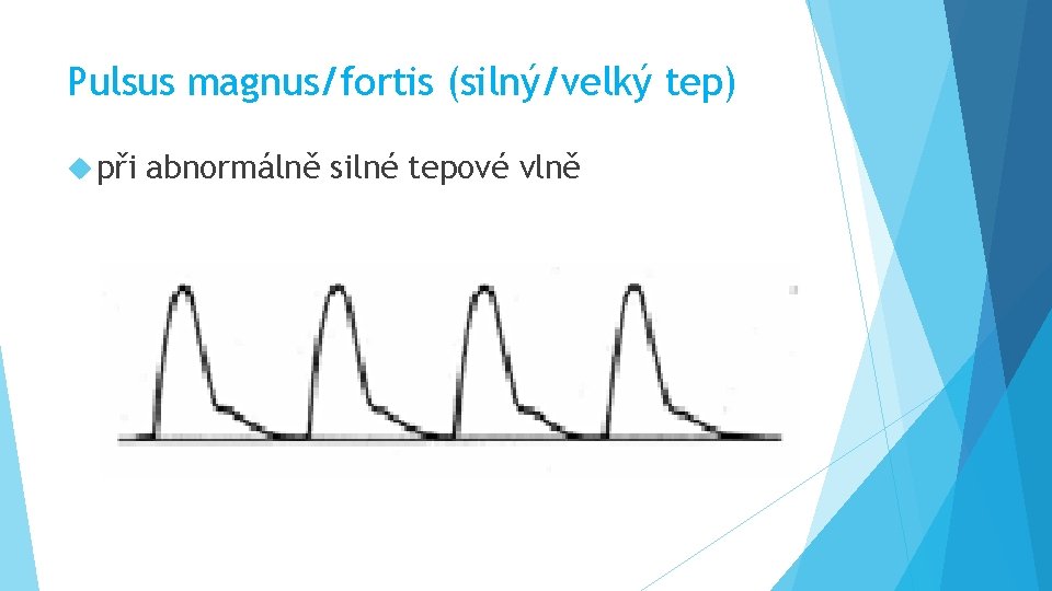 Pulsus magnus/fortis (silný/velký tep) při abnormálně silné tepové vlně 