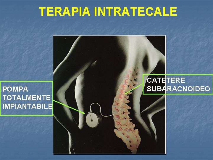 TERAPIA INTRATECALE POMPA TOTALMENTE IMPIANTABILE CATETERE SUBARACNOIDEO 