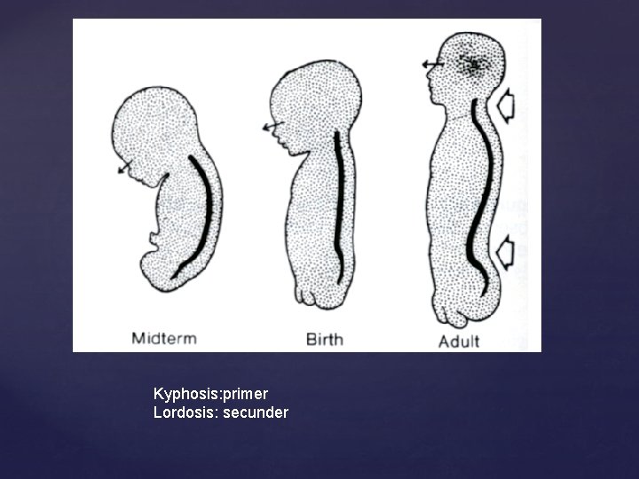 Kyphosis: primer Lordosis: secunder 