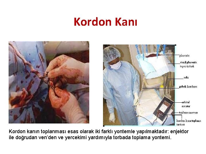 Kordon Kanı Kordon kanın toplanması esas olarak iki farklı yontemle yapılmaktadır: enjektor ile doğrudan
