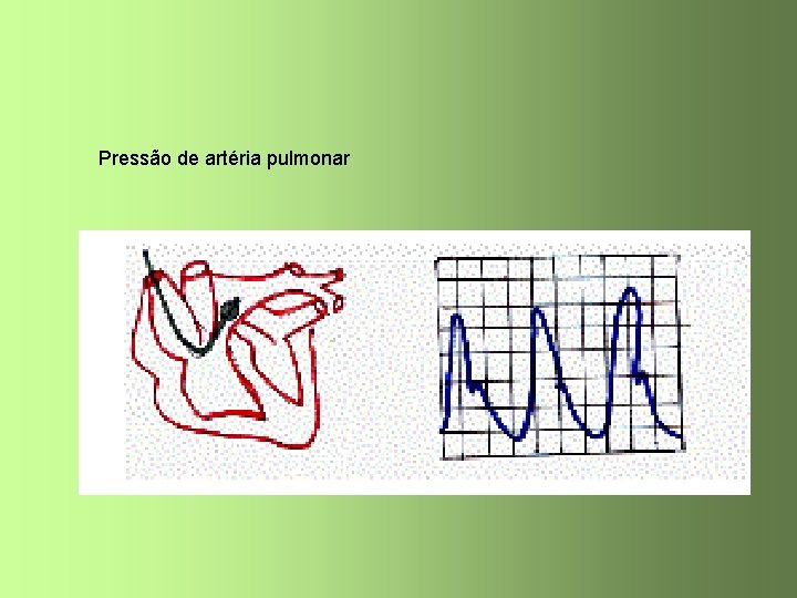 Pressão de artéria pulmonar 