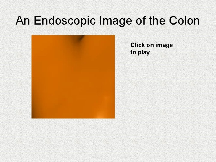 An Endoscopic Image of the Colon Click on image to play An Endoscopic Image of the Colon Click on image to play