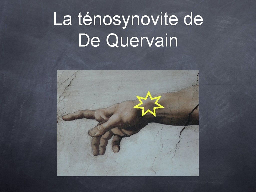 La ténosynovite de De Quervain 