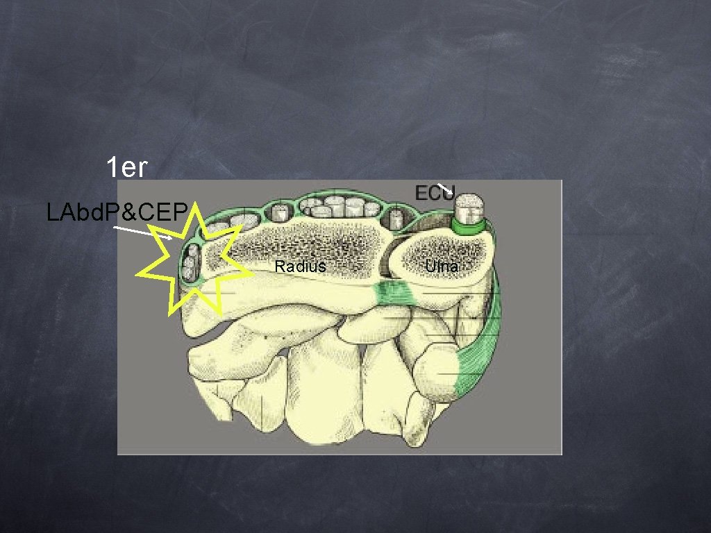 1 er LAbd. P&CEP Radius Ulna 