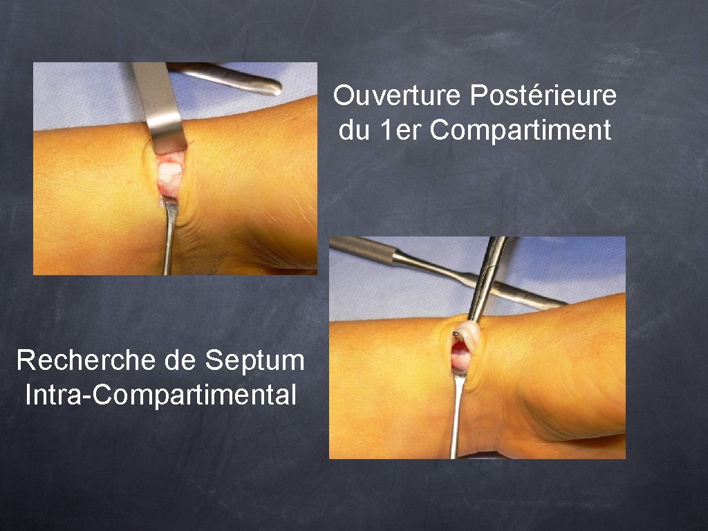 Ouverture Postérieure du 1 er Compartiment Recherche de Septum Intra-Compartimental 