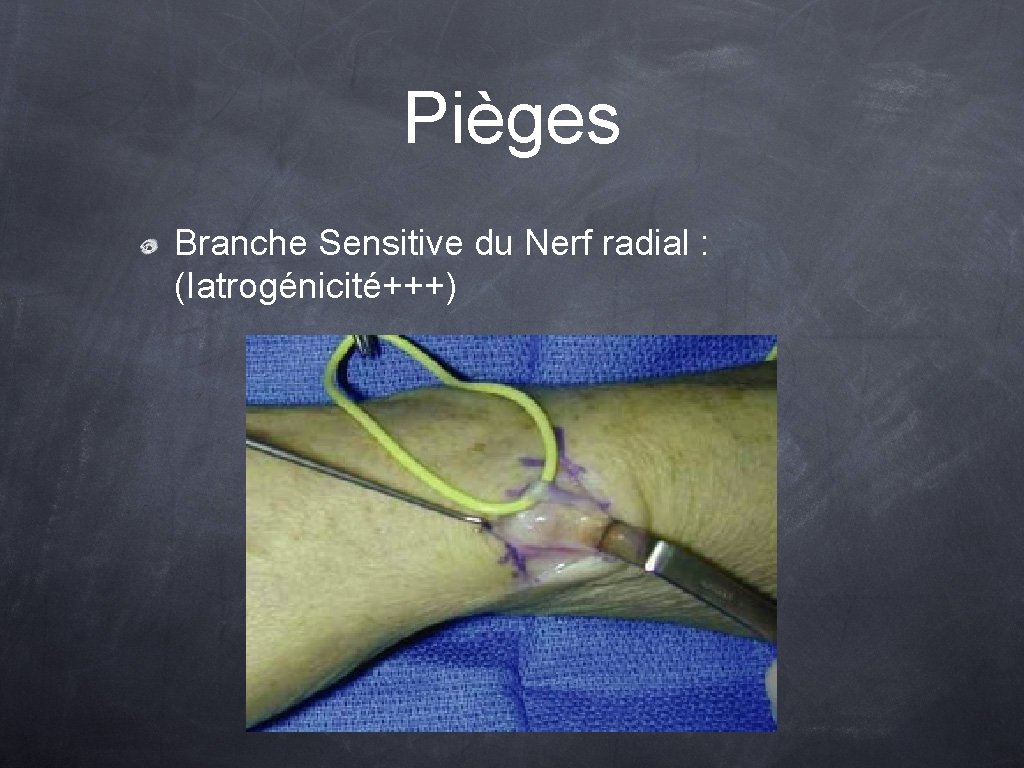 Pièges Branche Sensitive du Nerf radial : (Iatrogénicité+++) 