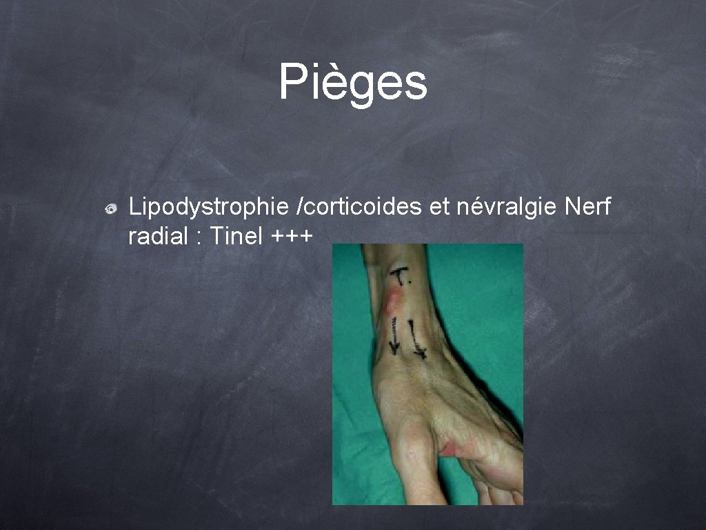 Pièges Lipodystrophie /corticoides et névralgie Nerf radial : Tinel +++ 