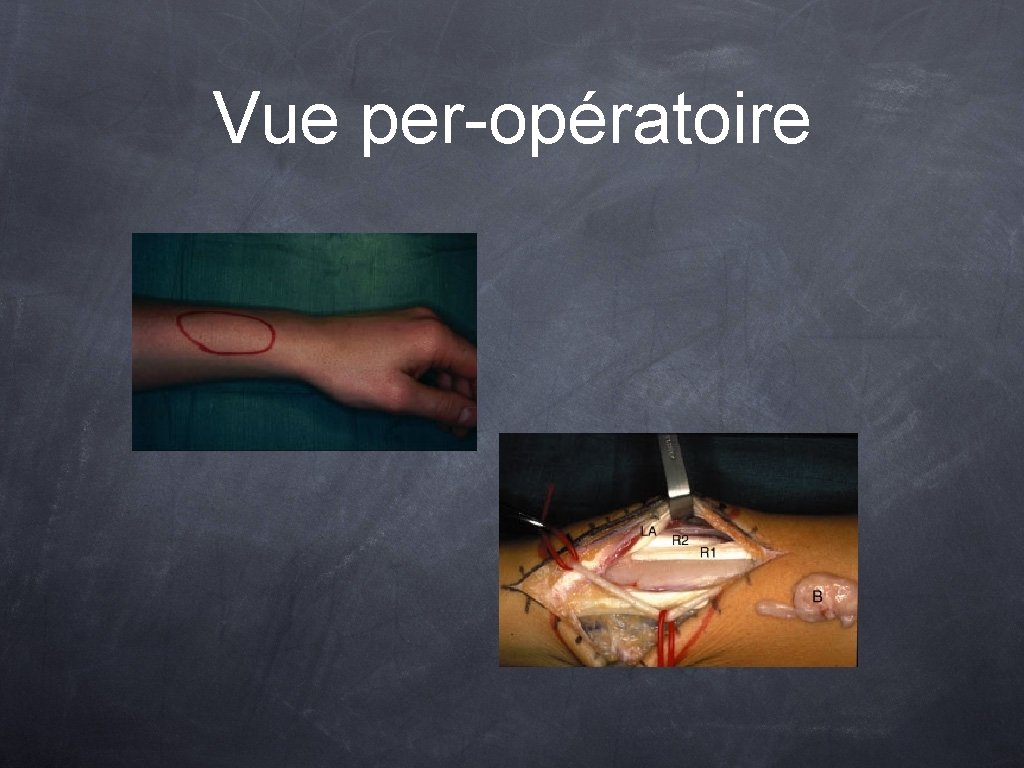 Vue per-opératoire 