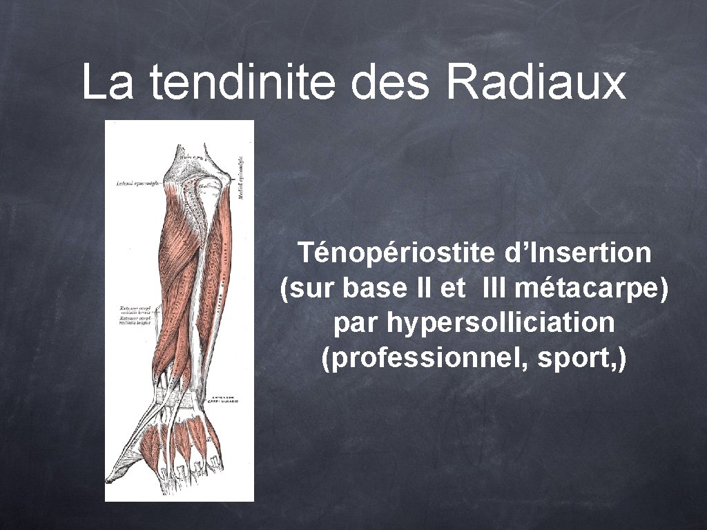 La tendinite des Radiaux Ténopériostite d’Insertion (sur base II et III métacarpe) par hypersolliciation