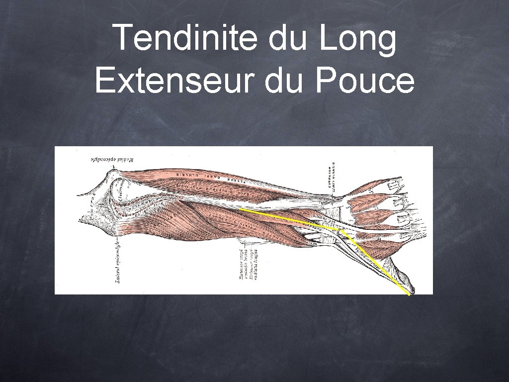 Tendinite du Long Extenseur du Pouce 