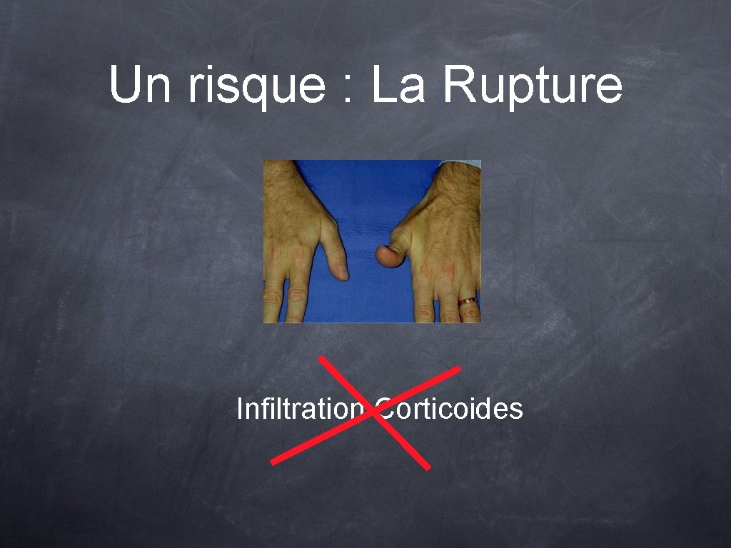 Un risque : La Rupture Infiltration Corticoides 