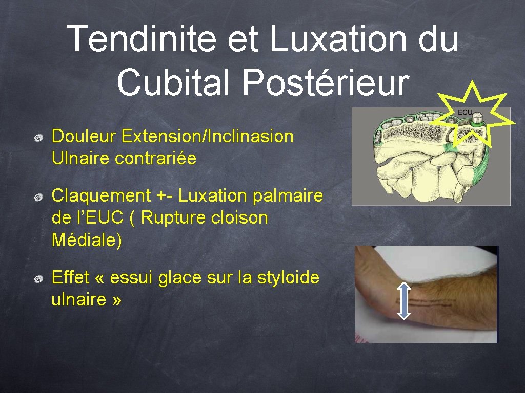 Tendinite et Luxation du Cubital Postérieur Douleur Extension/Inclinasion Ulnaire contrariée Claquement +- Luxation palmaire