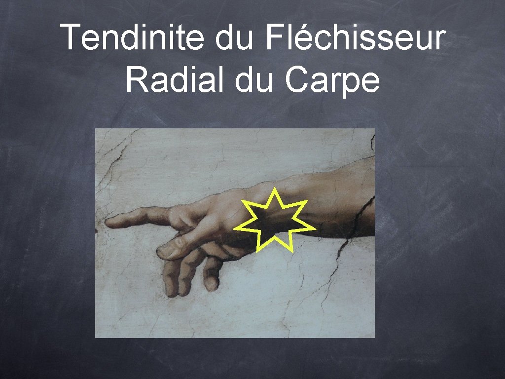 Tendinite du Fléchisseur Radial du Carpe 