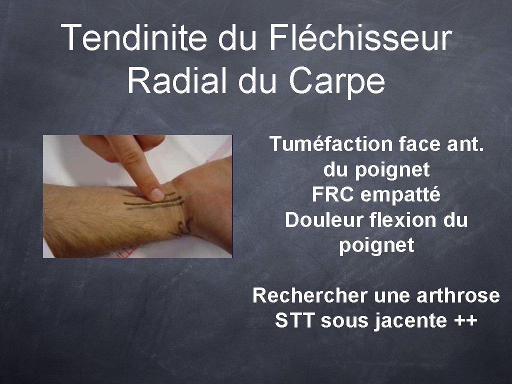 Tendinite du Fléchisseur Radial du Carpe Tuméfaction face ant. du poignet FRC empatté Douleur