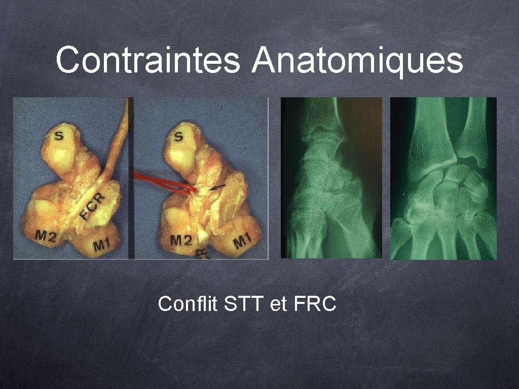 Contraintes Anatomiques Conflit STT et FRC 