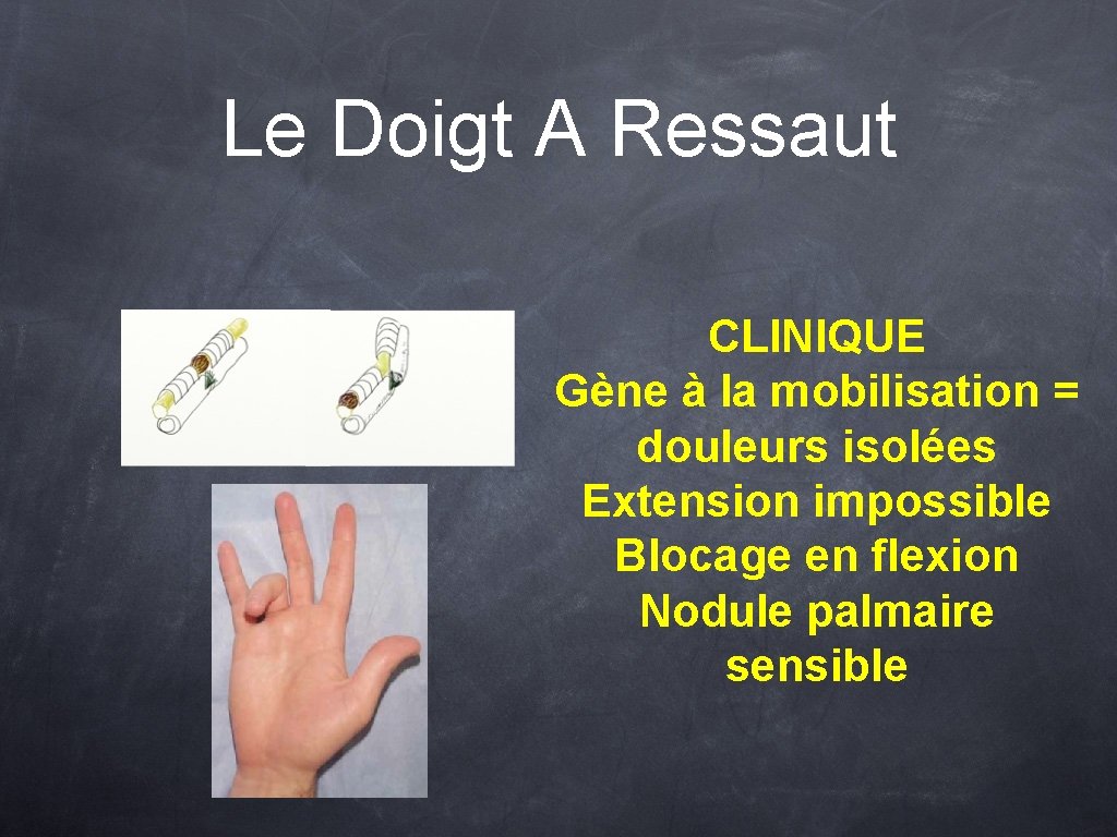 Le Doigt A Ressaut CLINIQUE Gène à la mobilisation = douleurs isolées Extension impossible