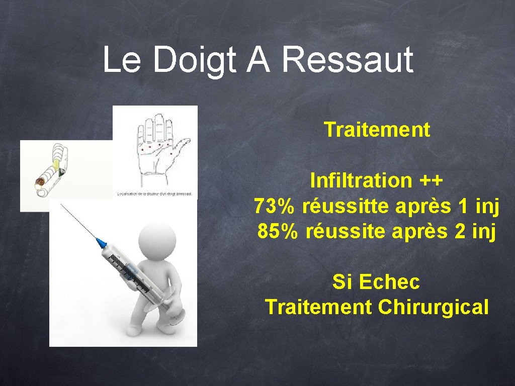 Le Doigt A Ressaut Traitement Infiltration ++ 73% réussitte après 1 inj 85% réussite