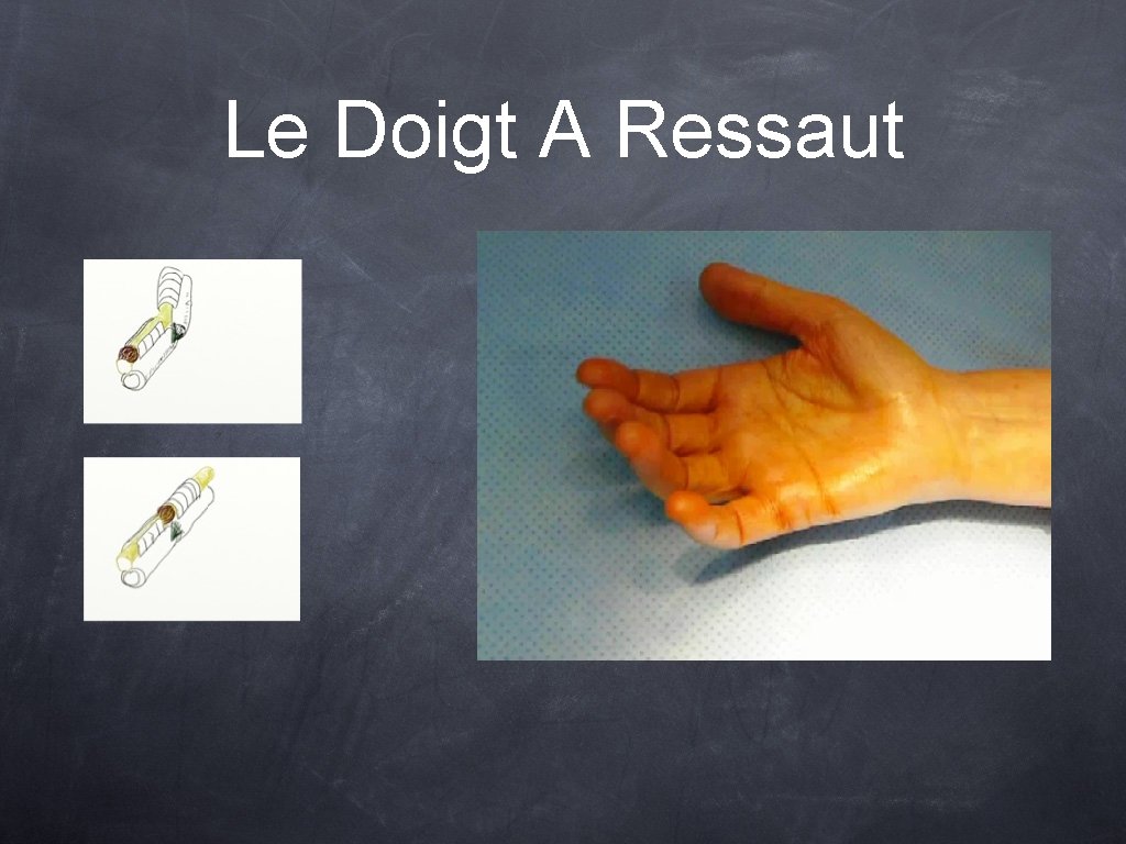 Le Doigt A Ressaut 