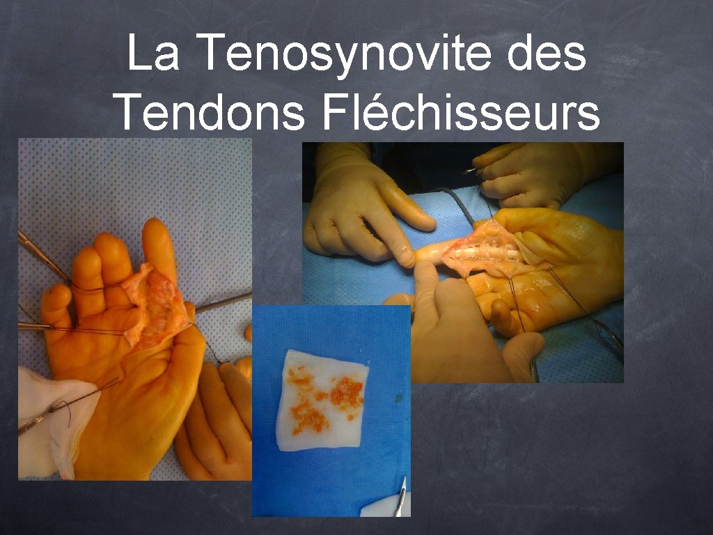 La Tenosynovite des Tendons Fléchisseurs 