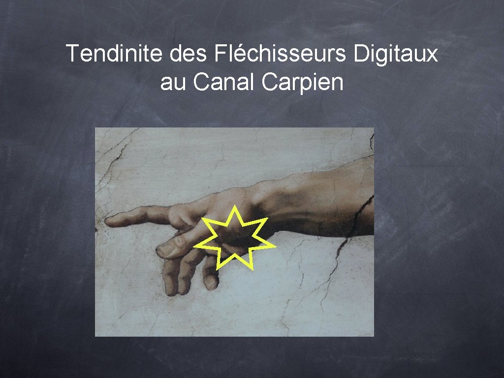 Tendinite des Fléchisseurs Digitaux au Canal Carpien 