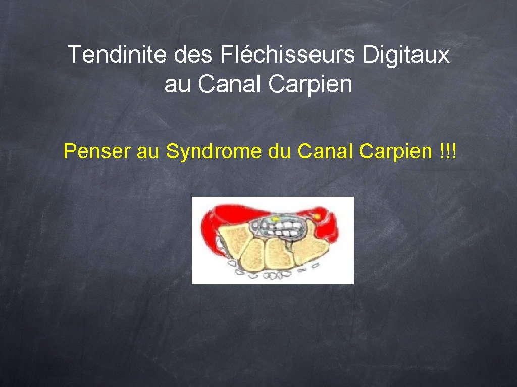 Tendinite des Fléchisseurs Digitaux au Canal Carpien Penser au Syndrome du Canal Carpien !!!