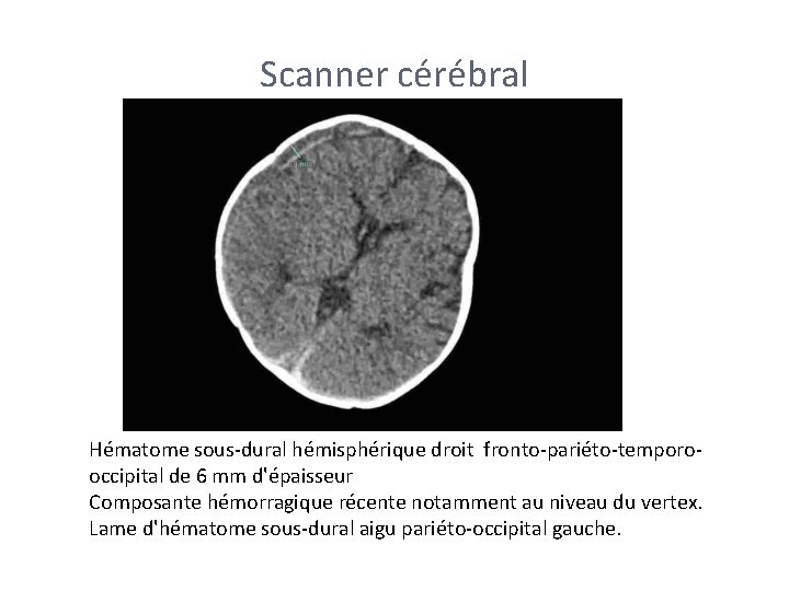 Scanner cérébral Hématome sous-dural hémisphérique droit fronto-pariéto-temporooccipital de 6 mm d'épaisseur Composante hémorragique récente