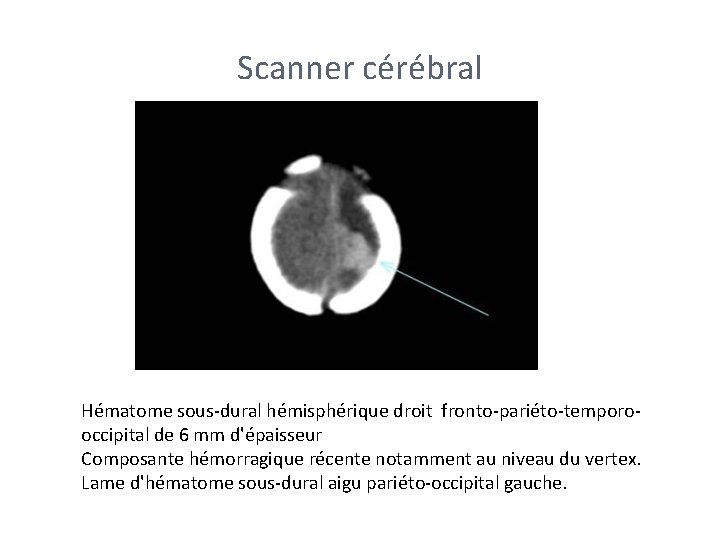 Scanner cérébral Hématome sous-dural hémisphérique droit fronto-pariéto-temporooccipital de 6 mm d'épaisseur Composante hémorragique récente