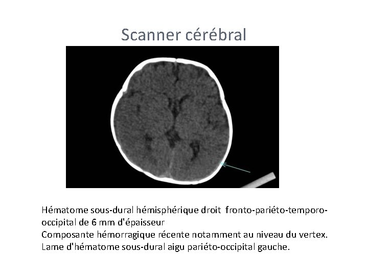 Scanner cérébral Hématome sous-dural hémisphérique droit fronto-pariéto-temporooccipital de 6 mm d'épaisseur Composante hémorragique récente