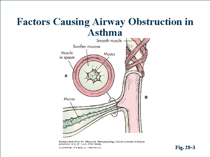 Factors Causing Airway Obstruction in Asthma Fig. 28 -3 