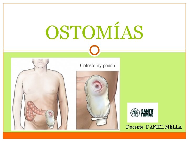 OSTOMÍAS Docente: DANIEL MELLA OSTOMÍAS Docente: DANIEL MELLA