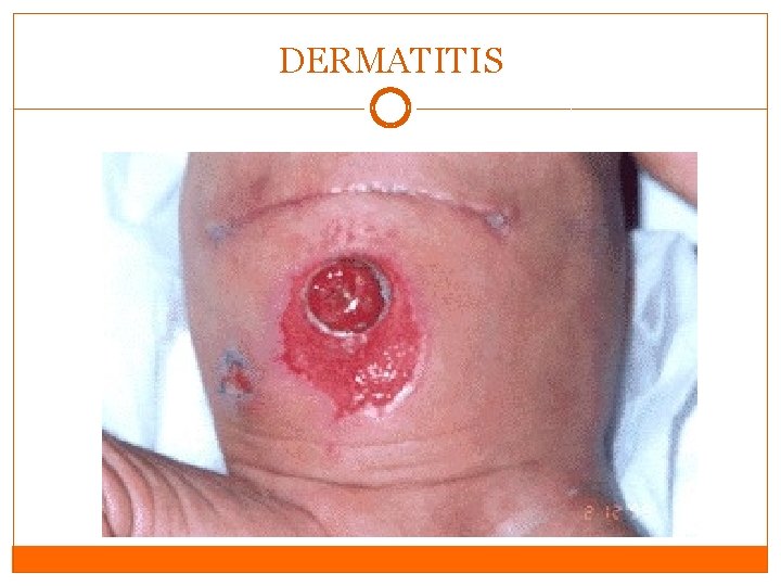 DERMATITIS DERMATITIS