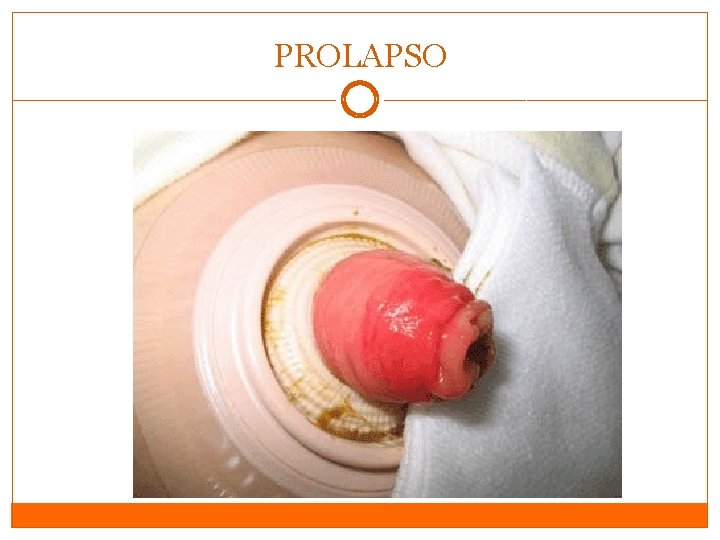 PROLAPSO PROLAPSO