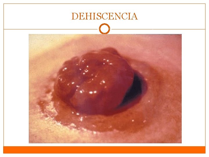 DEHISCENCIA DEHISCENCIA
