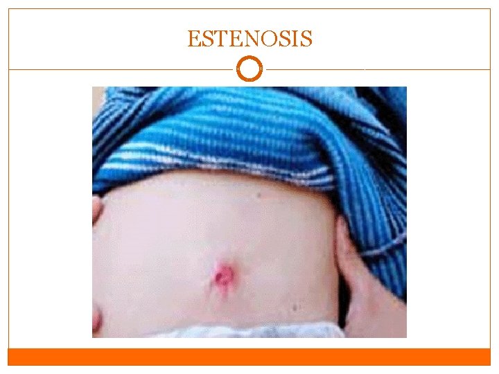 ESTENOSIS ESTENOSIS