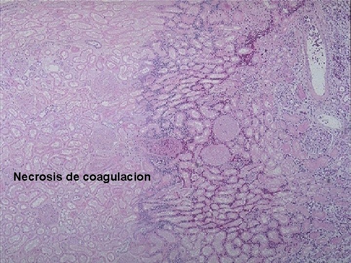 Necrosis de coagulacion 