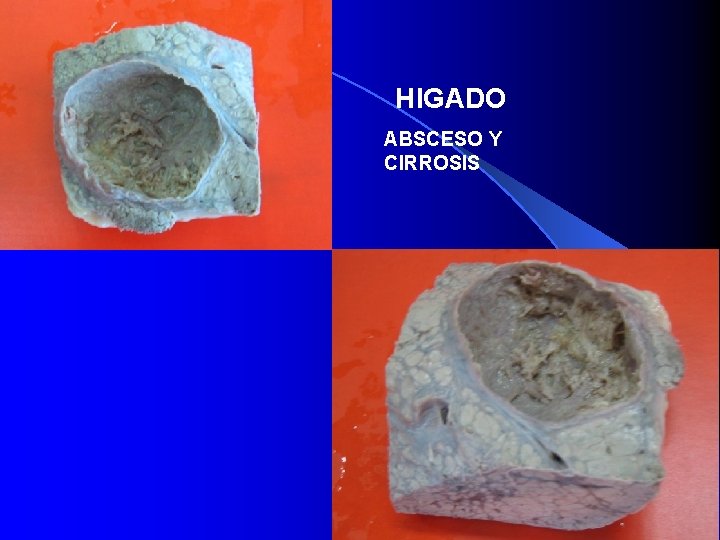 HIGADO ABSCESO Y CIRROSIS 