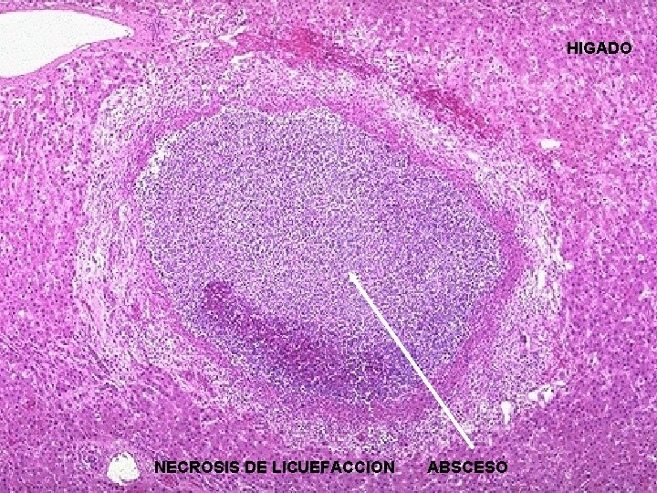 HIGADO NECROSIS DE LICUEFACCION ABSCESO 