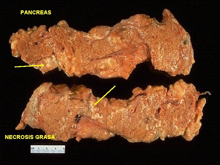 PANCREAS NECROSIS GRASA 