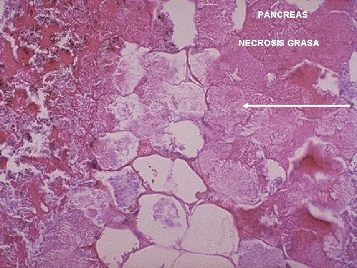 PANCREAS NECROSIS GRASA 