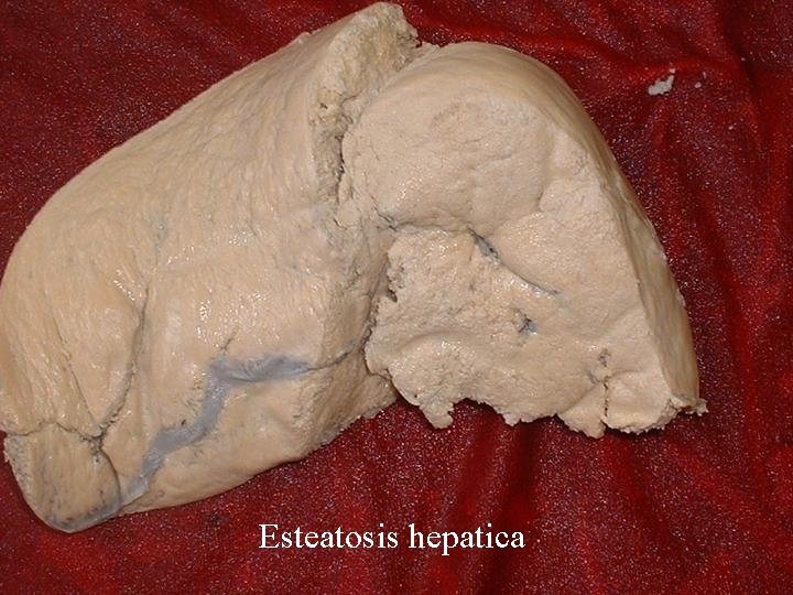 Esteatosis hepatica 