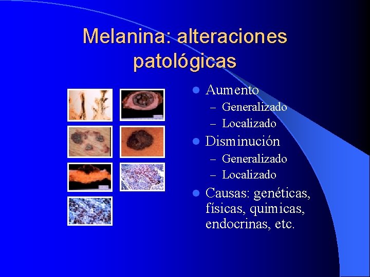 Melanina: alteraciones patológicas l Aumento – Generalizado – Localizado l Disminución – Generalizado –