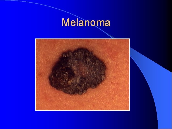 Melanoma 