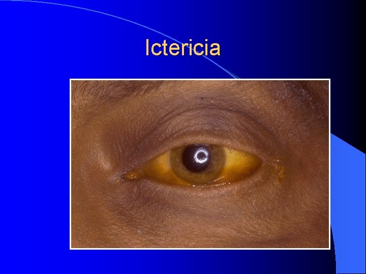 Ictericia 