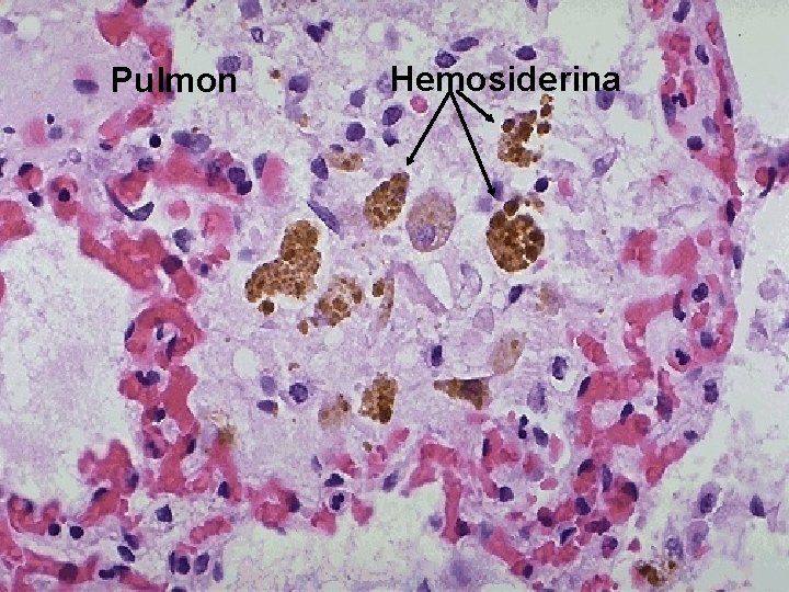 Pulmon Hemosiderina 