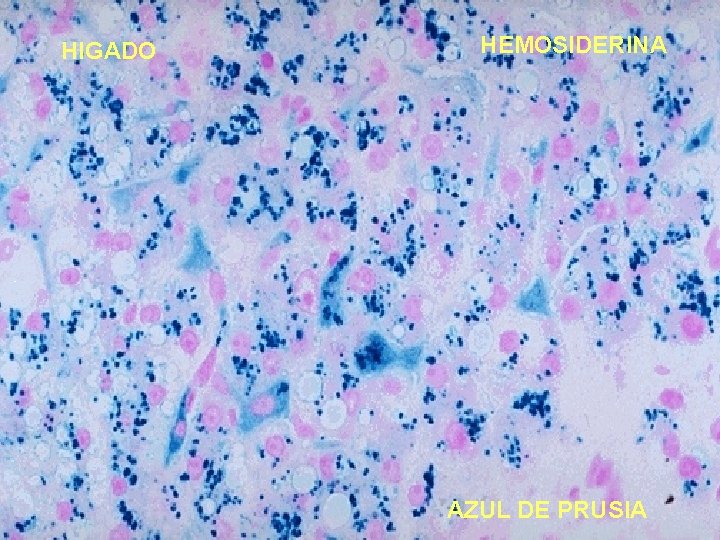 HIGADO HEMOSIDERINA AZUL DE PRUSIA 