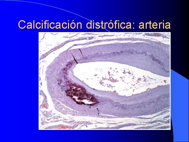 Calcificación distrófica: arteria 