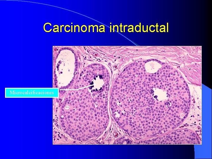 Carcinoma intraductal Microcalcificaciones 