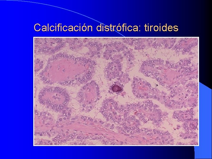 Calcificación distrófica: tiroides 